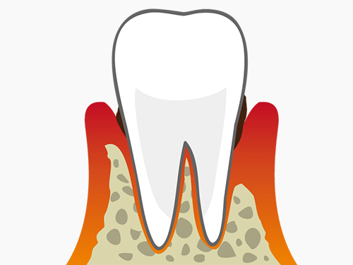歯ぐきの炎症による痛み