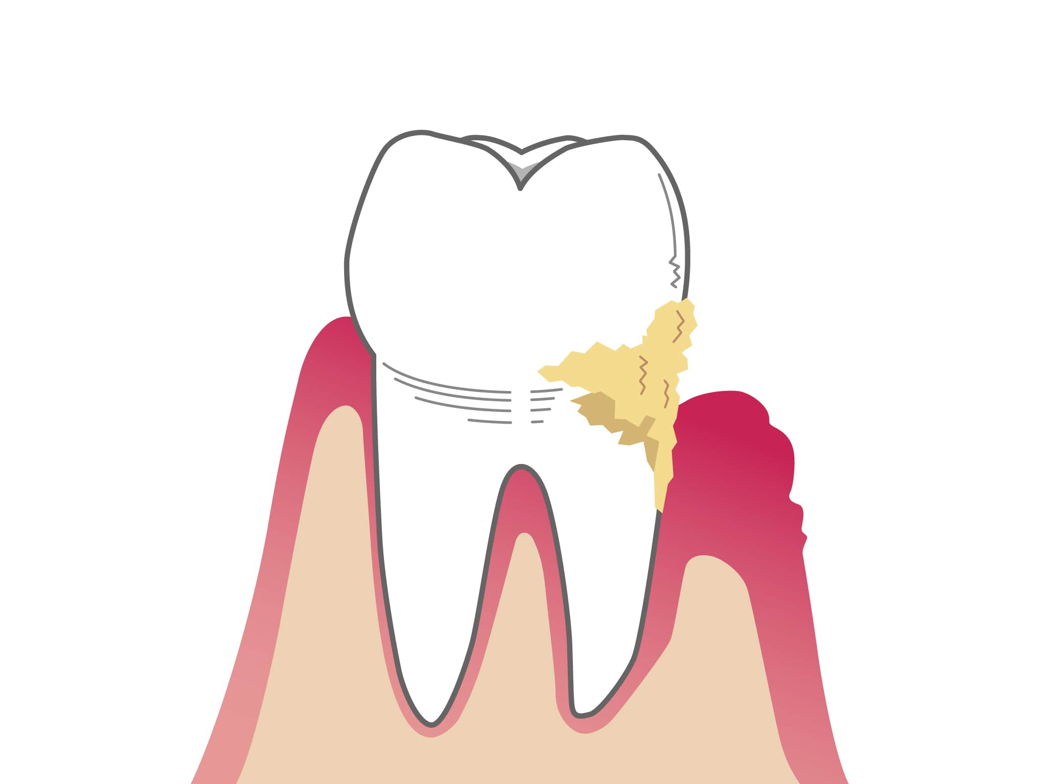 歯周病って何！？