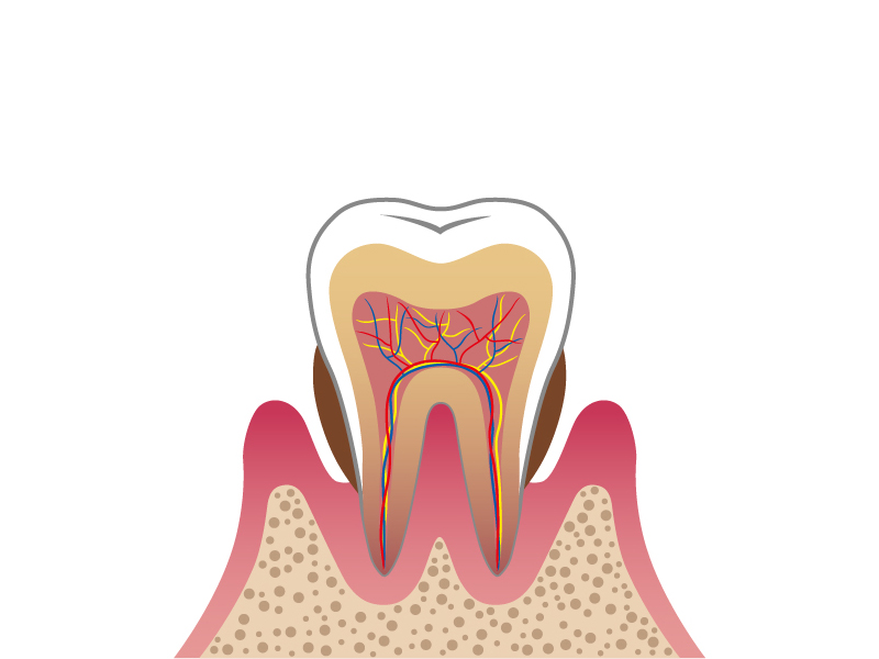 【後期】中程度歯周炎